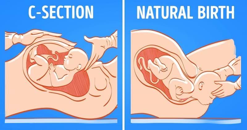 C-Section or Natural Birth