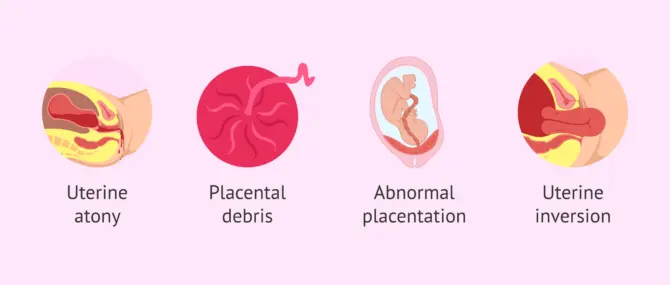 Postpartum Hemorrhage