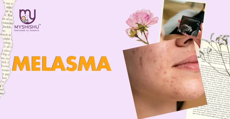 Melasma Pregnancy