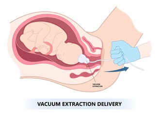 ventouse delivery in pregnancy